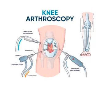 Robotic Knee Arthroscopy surgery