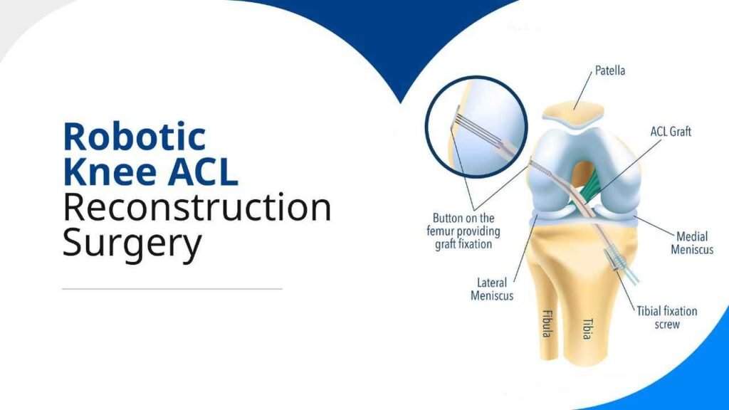 Robotic Knee ACL Reconstruction Surgery Robotic Knee Replacement Surgery robotic-knee-acl-reconstruction-surgery-robotic-knee-replacement-surgery