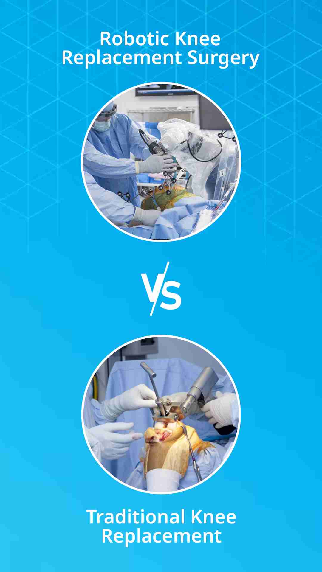 Robotic Knee Replacement Surgery vs. Traditional Knee Replacement Surgery