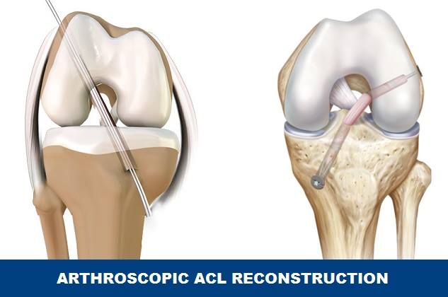 Robotic knee ACL