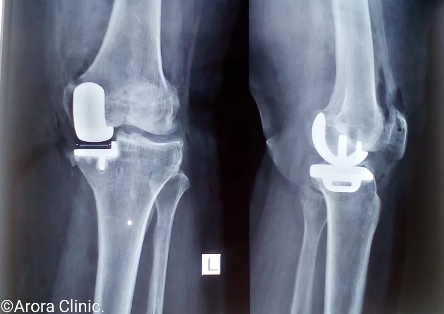 Benefits of Partial Knee Replacement Surgery